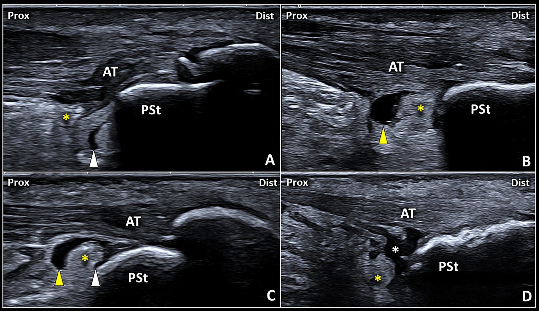 Bursa retrocalcanea 4 Tempo Formacion ecografia.jpg